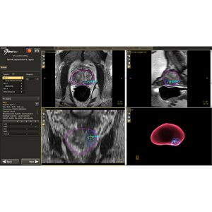 UroNav prostate cancer screening biopsy imaging
